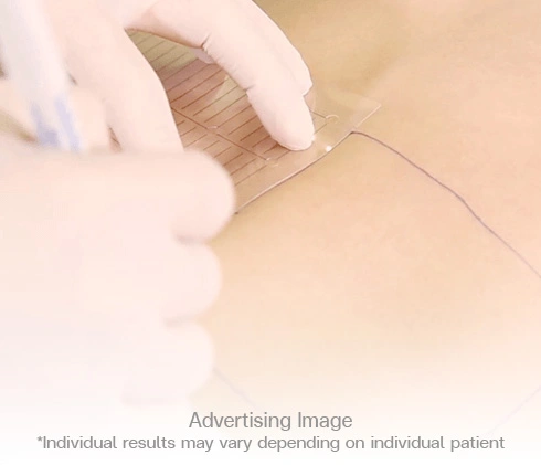 2. Marks are drawn to pinpoint the site prior to treatment.