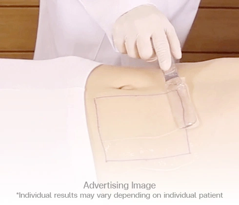 3. Topical numbing cream is applied to the treated site.