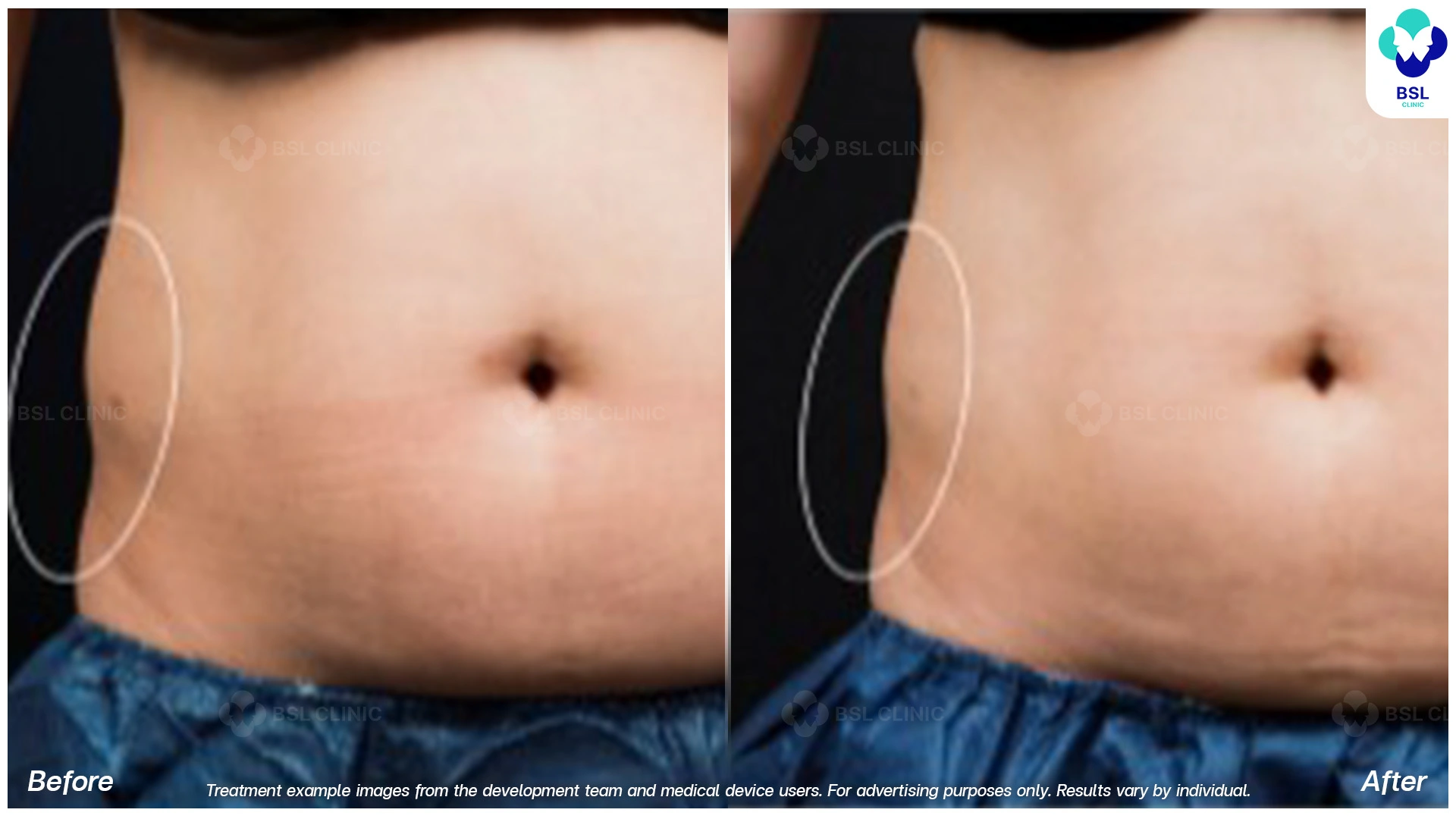 before after fat freezing waistline slimming with coolshaping2 program cryolipolysis treatment for love handles visible fat reduction no surgery non invasive body contouring results