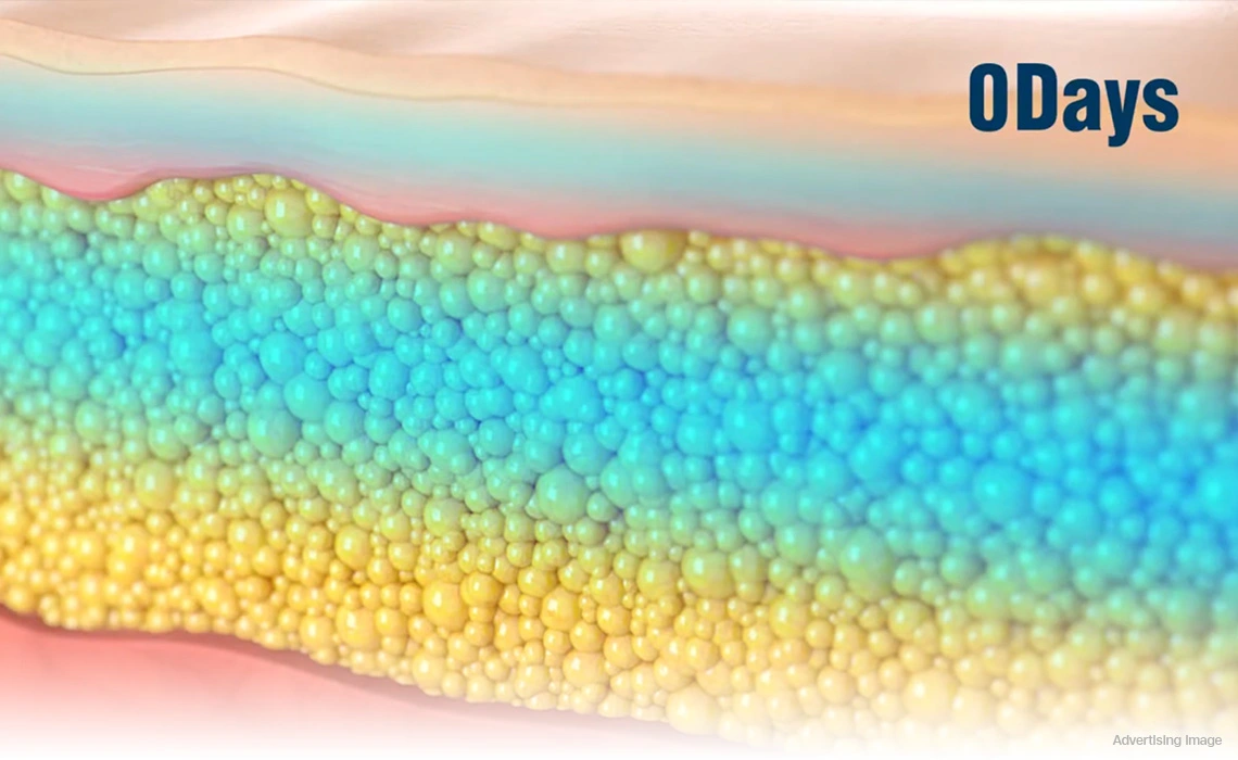 coolshaping fat freezing 0 days fat layer before cryolipolysis non surgical fat reduction body contouring treatment