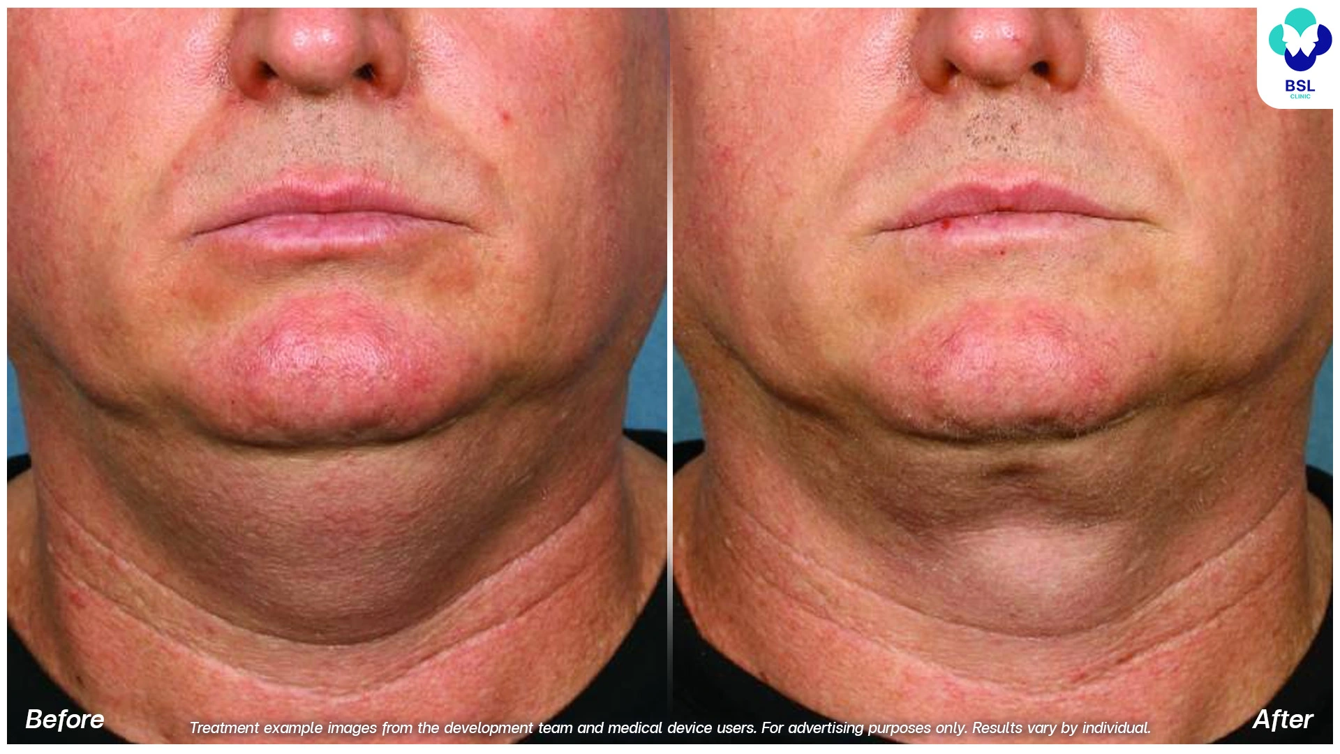 coolshaping2 double chin treatment fat freezing before after front view non surgical cryolipolysis fat reduction jawline contour cool sculpting results bangkok slimming