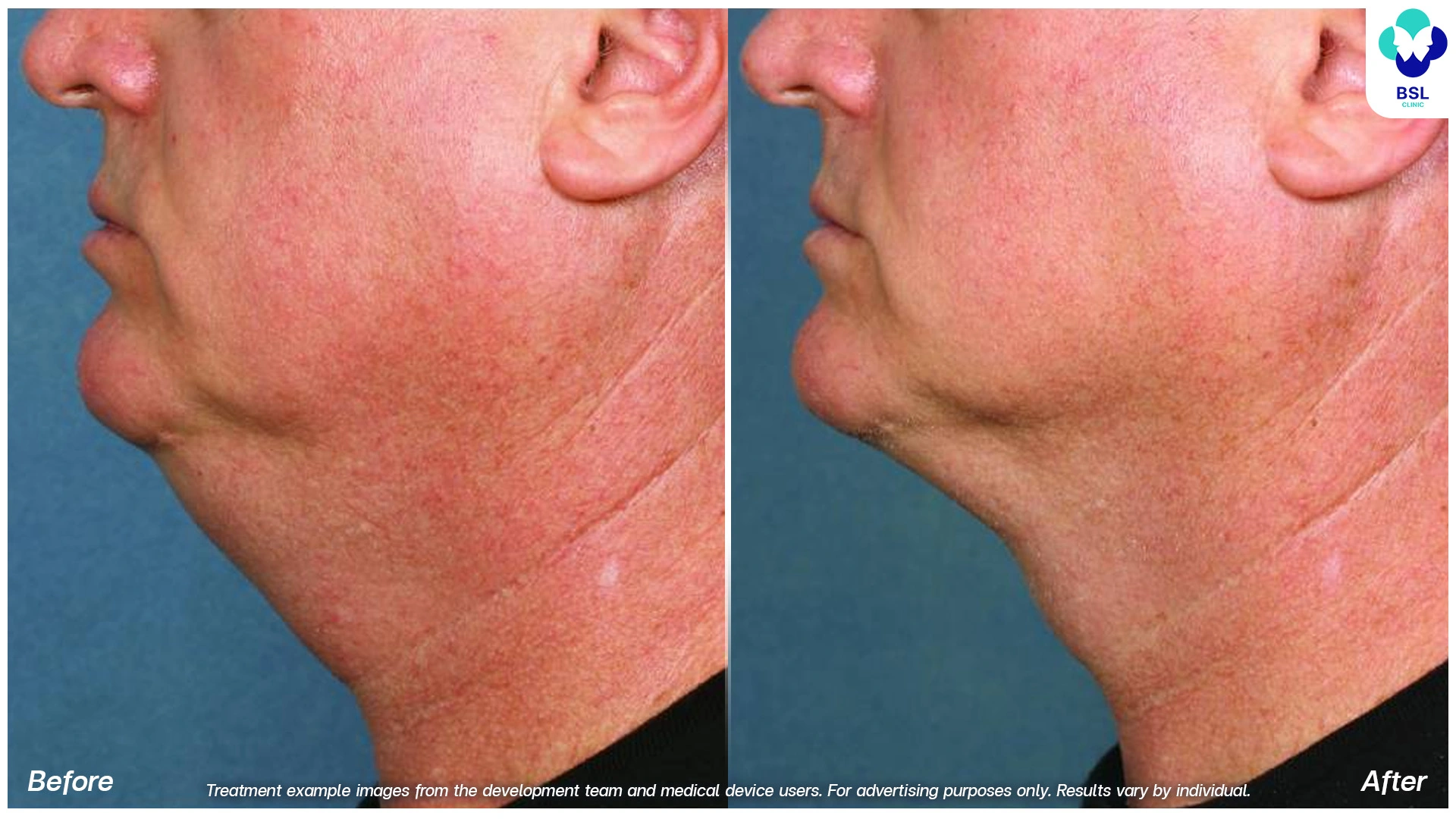 coolshaping2 submental fat reduction side profile fat freezing results jawline lift cryolipolysis neck sculpting non invasive cool sculpting bangkok fat loss clinic