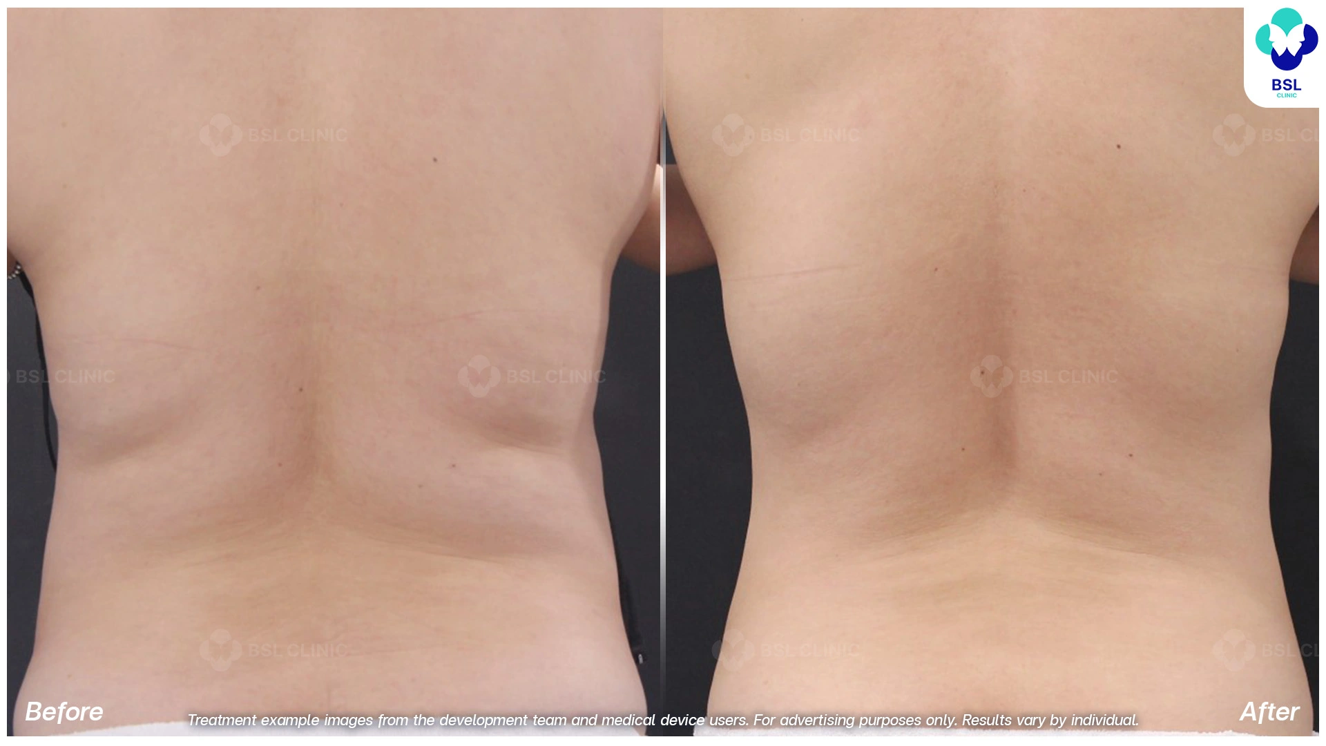 cryolipolysis visible results flank treatment fat reduction women