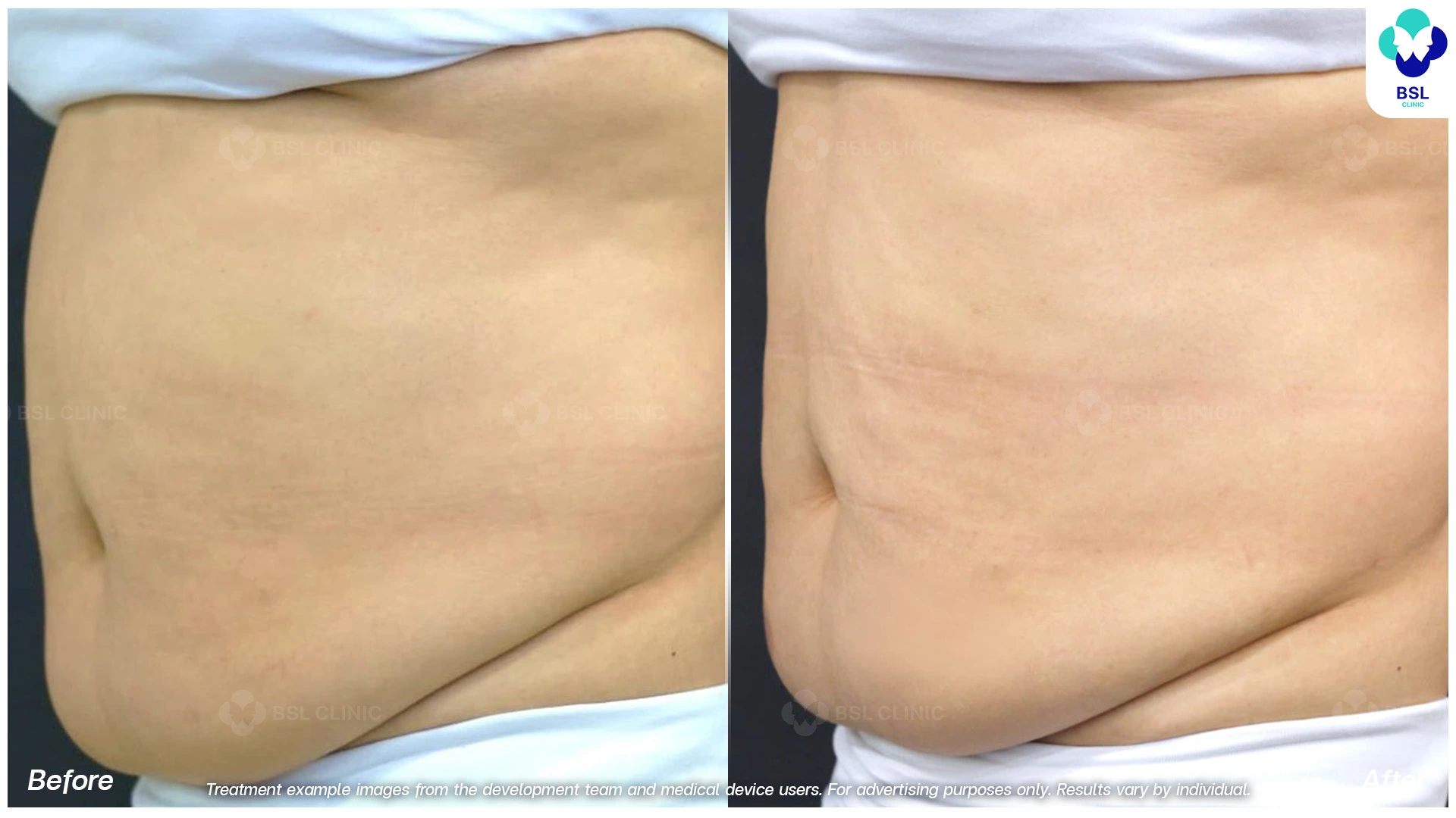 fat freezing before after back results coolshaping2 body contouring