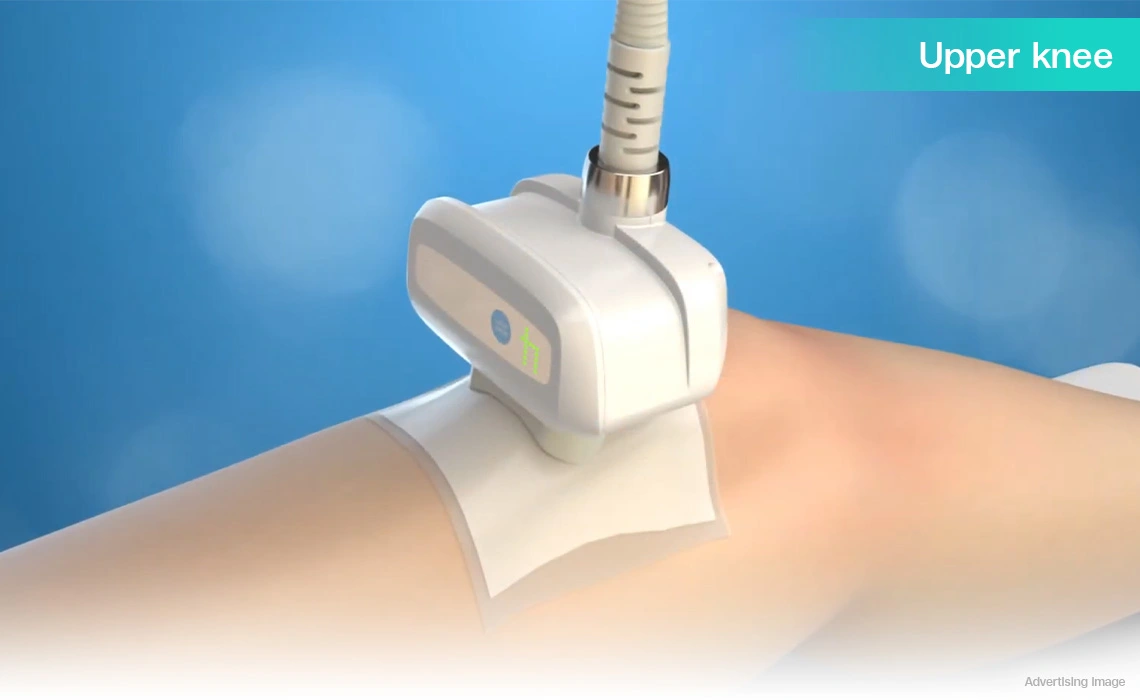 fat freezing upper knee treatment coolsculpting leg toning cryolipolysis