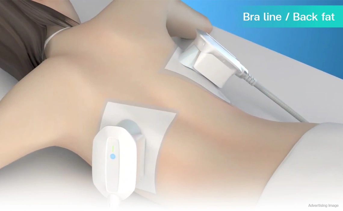 fat reduction bra line back fat treatment coolsculpting program