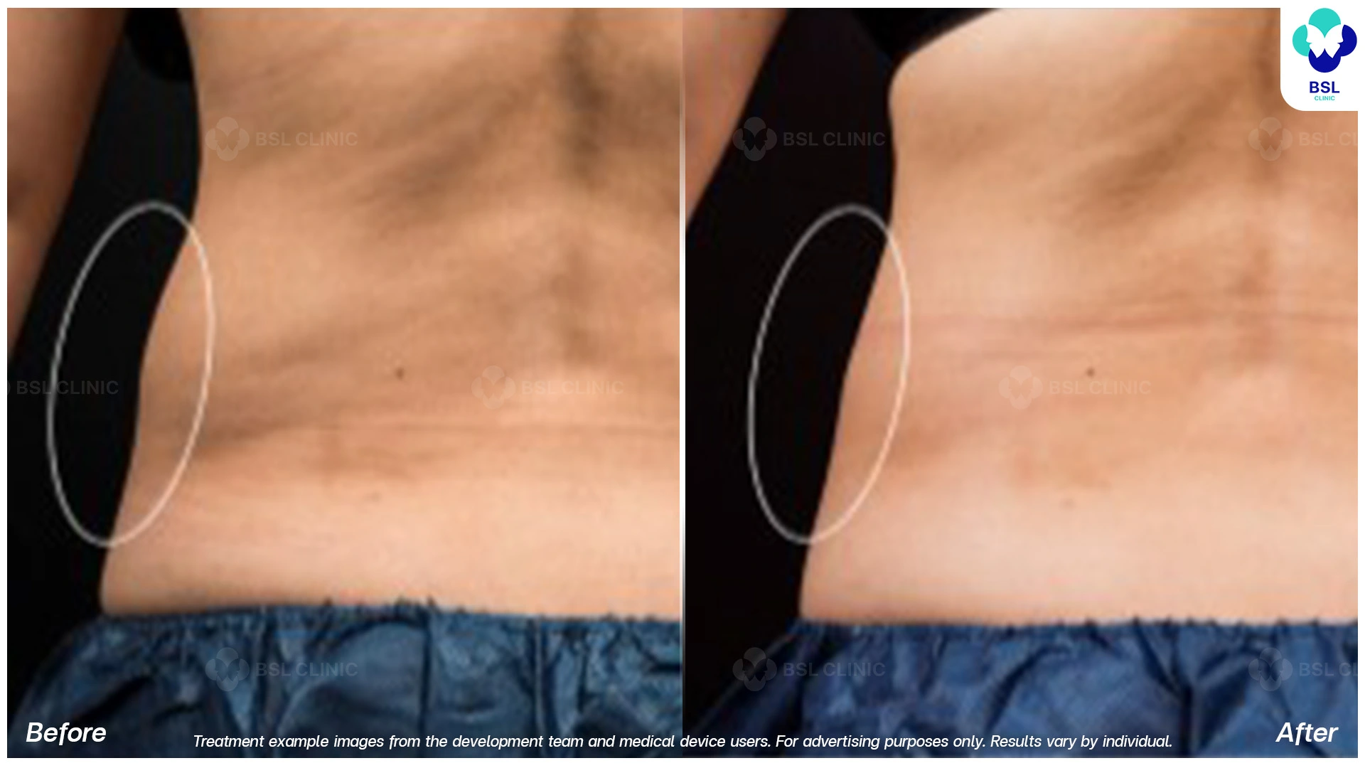 flank fat reduction before after coolsculpting vs coolshaping2 program fat freezing cryolipolysis lower abdomen side profile body slimming visible results waist contour enhancement