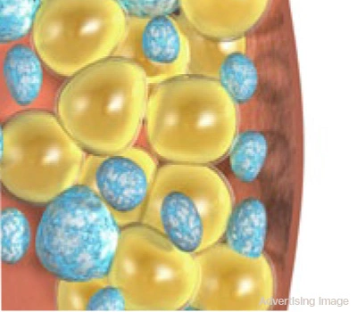 gradual breakdown of fat cells through immune response after coolshaping session