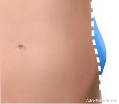 natural body transformation after cool sculpting fat freezing without downtime