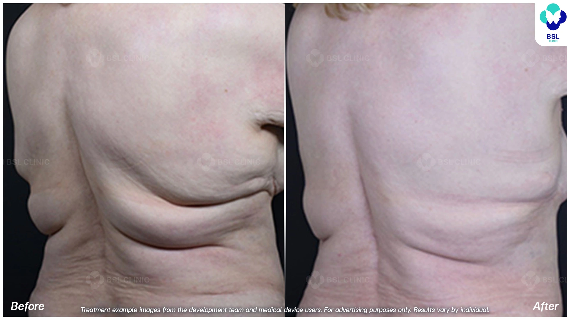 visible back fat reduction after coolshaping fat freezing session upper and lower back folds smoother skin tightening body contouring cryolipolysis treatment non invasive fat reduction solution for seniors cool sculpting before after photo
