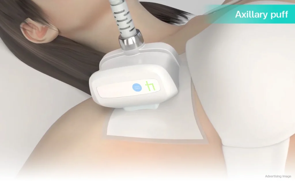 CoolShaping2-cryolipolysis-fat-freezing-axillary-puff-underarm-bulge-bra-fat-upper-side-back-body-contouring-fat-reduction-CoolSculpting