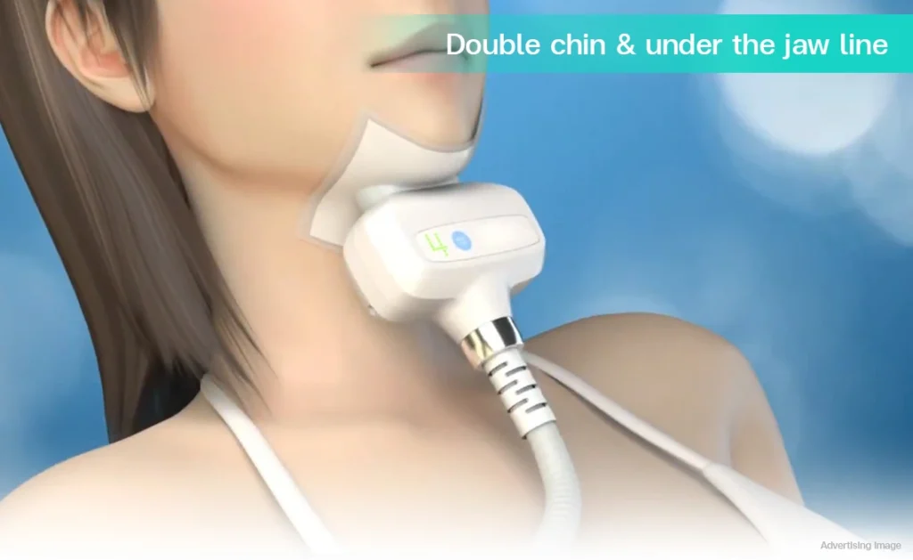 CoolShaping2 cryolipolysis fat freezing double chin removal chin fat reduction jawline definition body contouring CoolSculpting neck contour