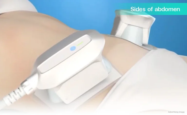 CoolShaping2 fat freezing technology body contouring fat reduction CoolSculpting flank treatment
