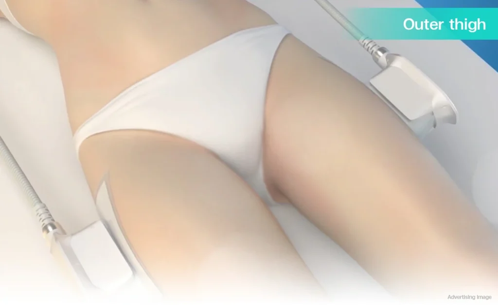 CoolShaping2 cryolipolysis fat freezing outer thigh fat thigh fat removal body contouring fat reduction CoolSculpting thigh slimming