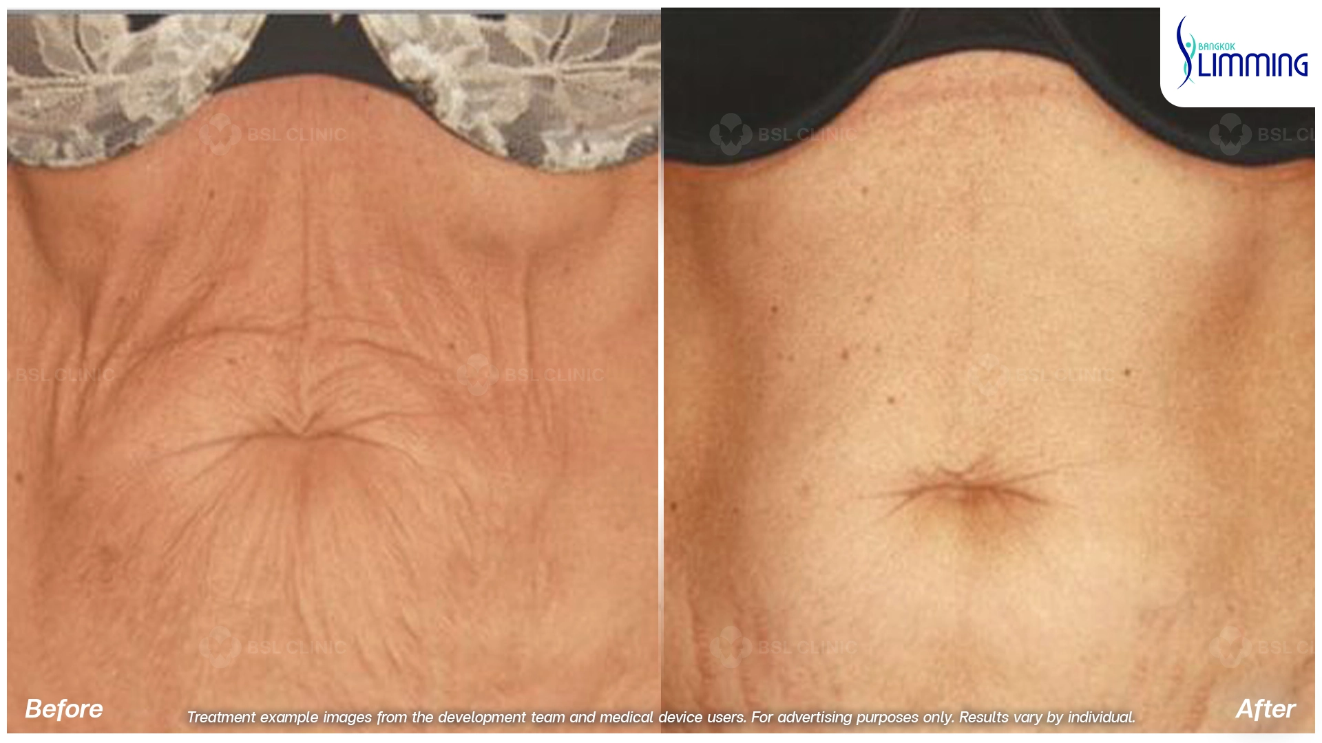 Flank Treatment results