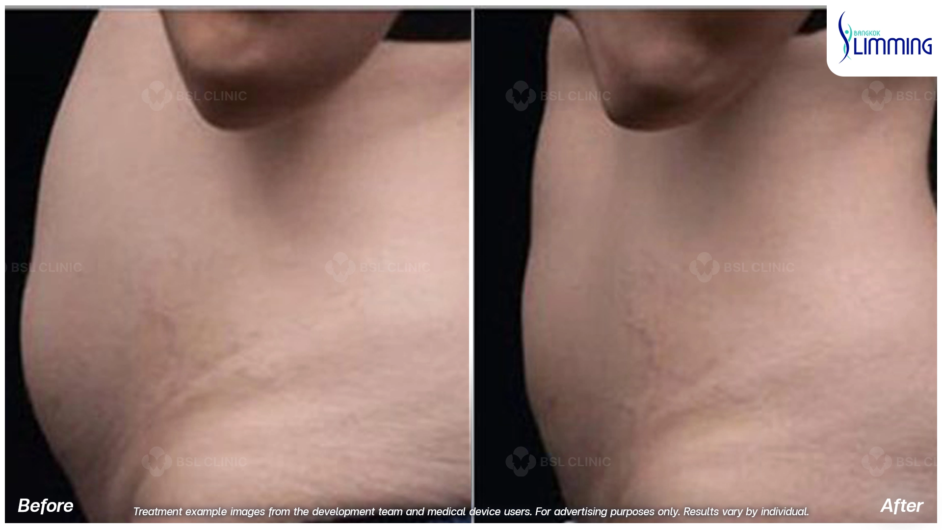 Flank Treatment results