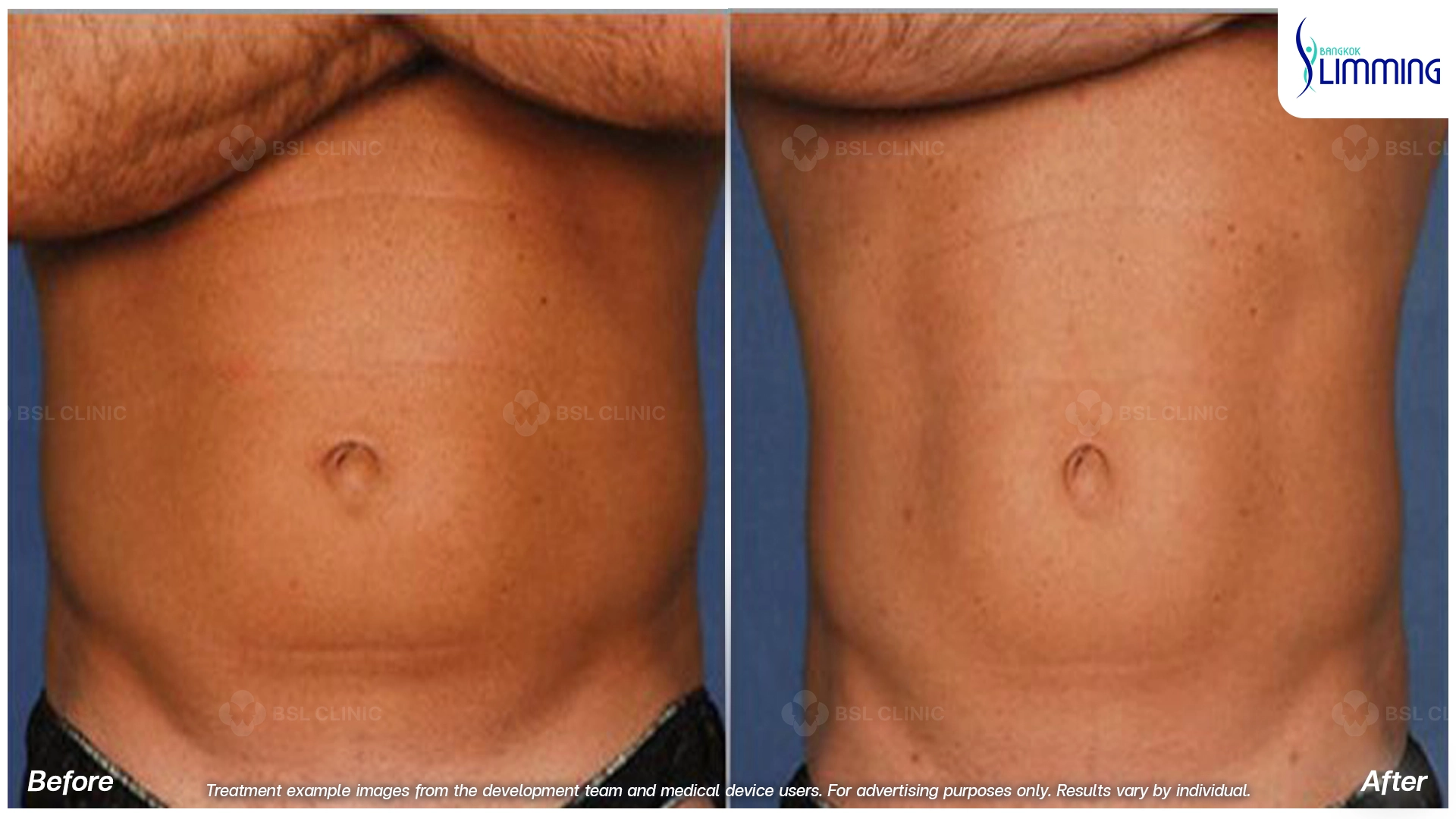 Flank Treatment results