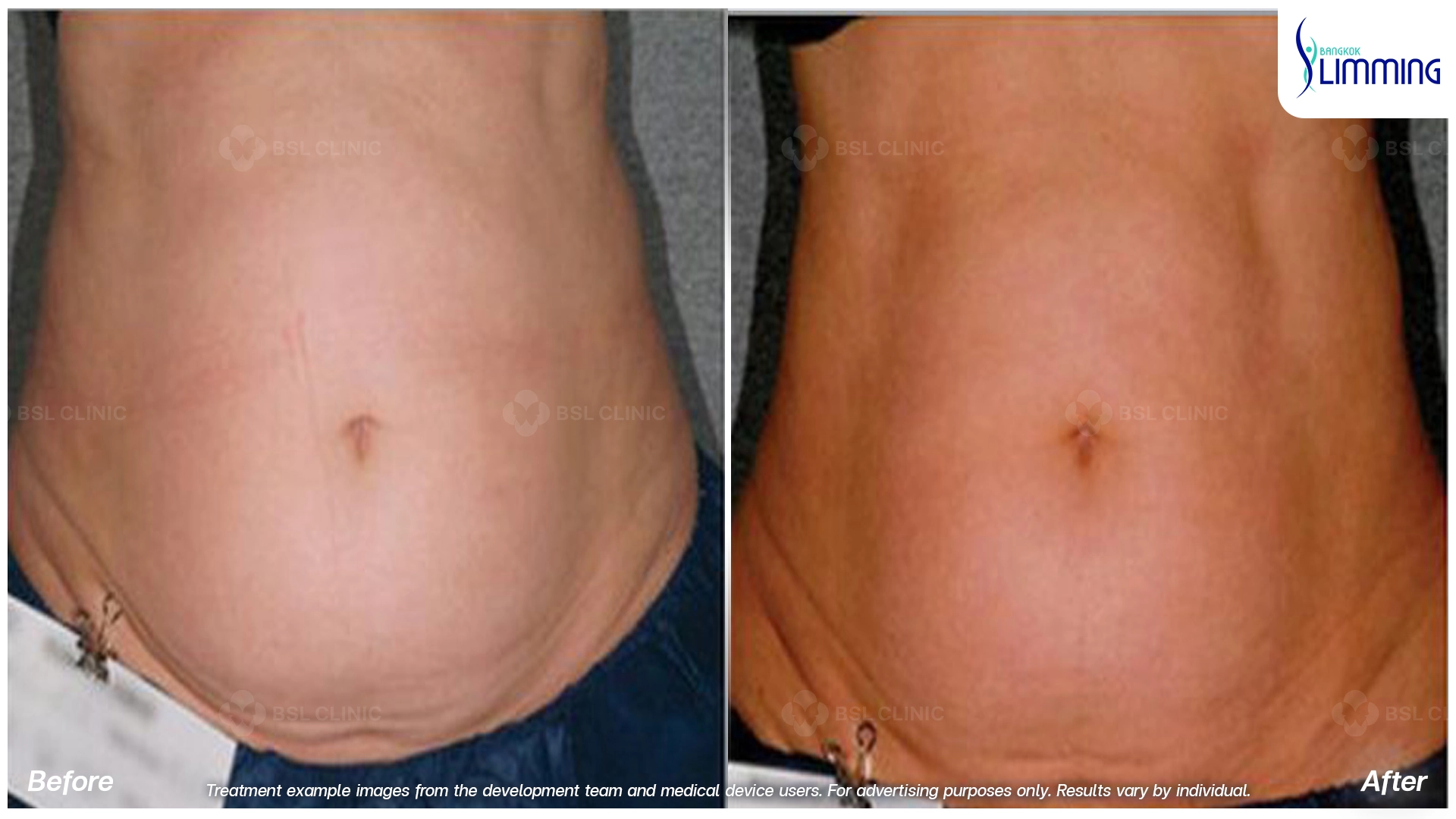 Flank Treatment results