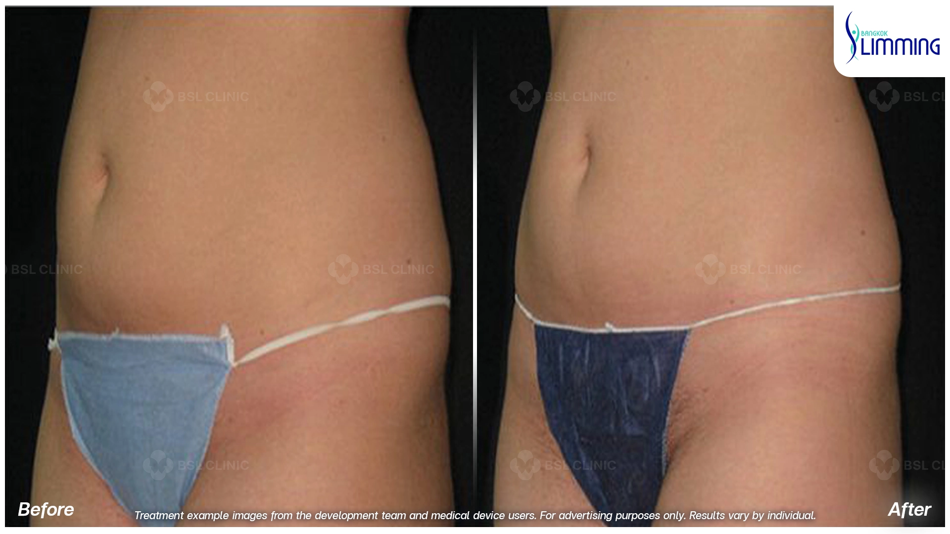 Flank Treatment results
