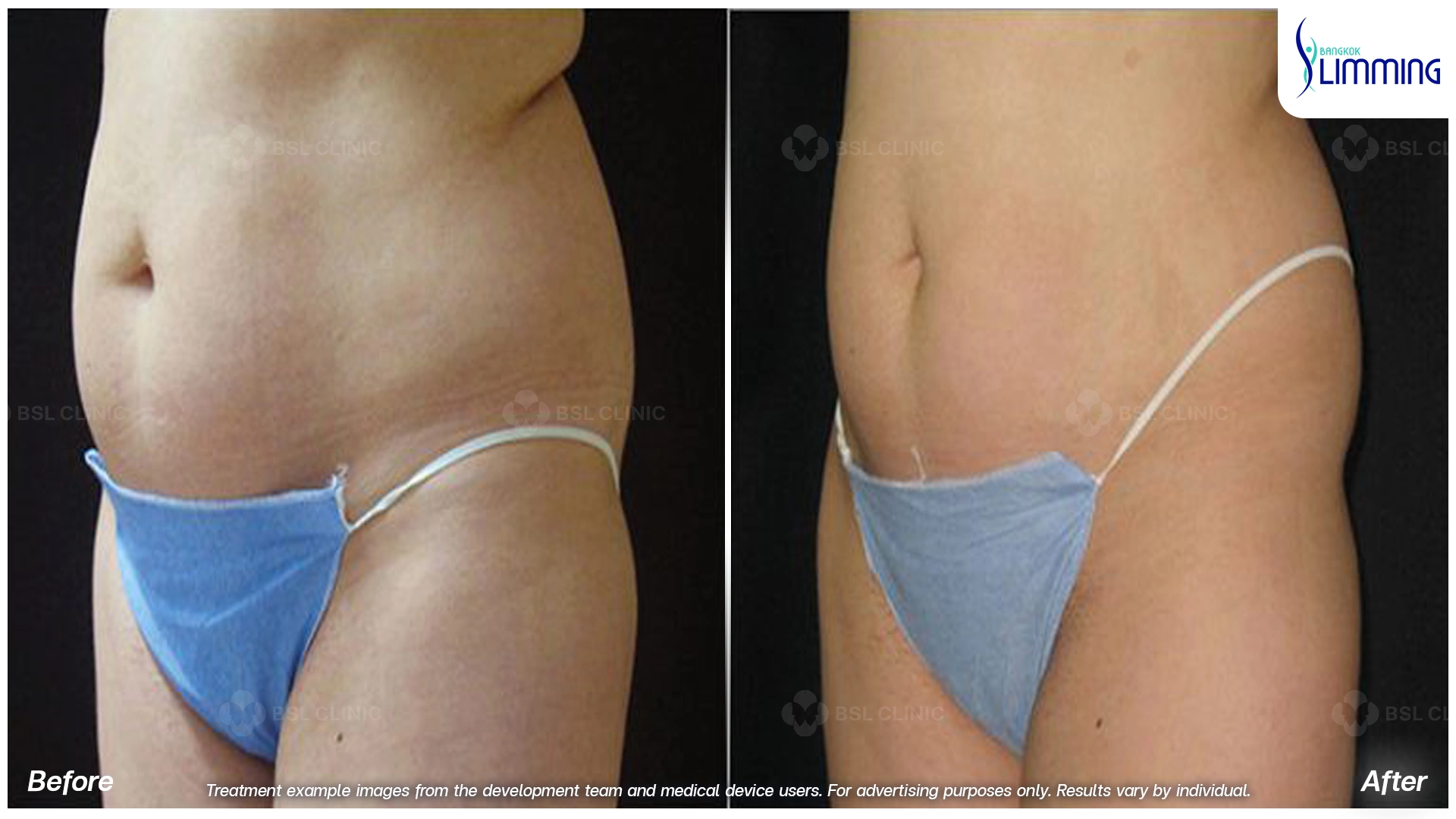 Flank Treatment results