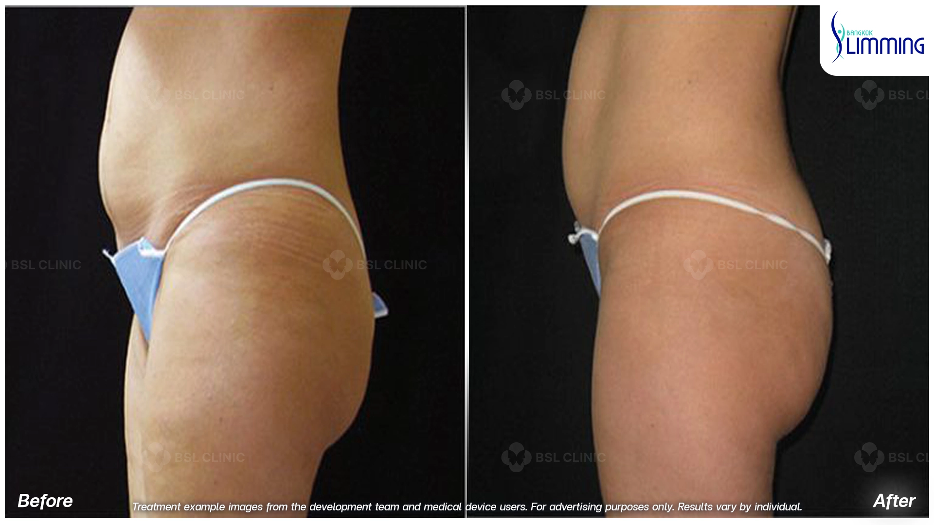 Flank Treatment results