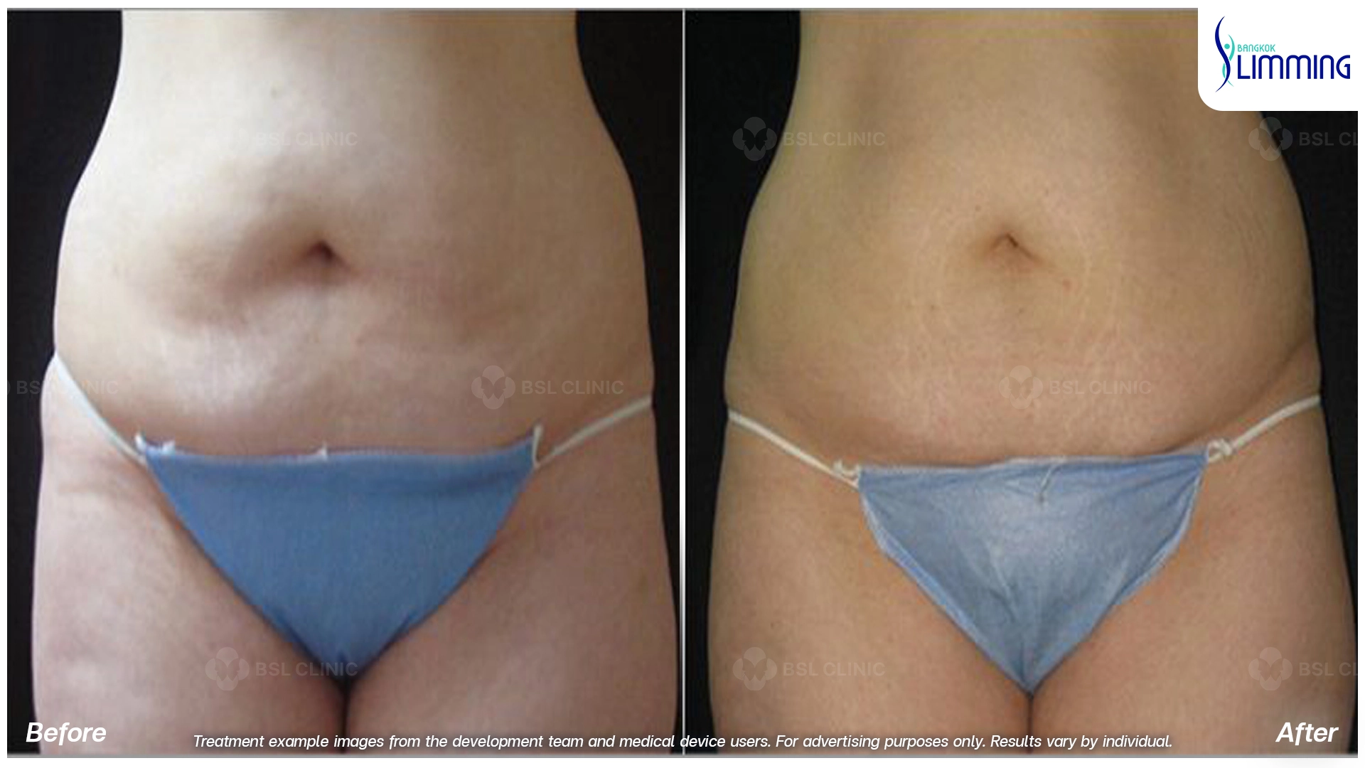 Flank Treatment results