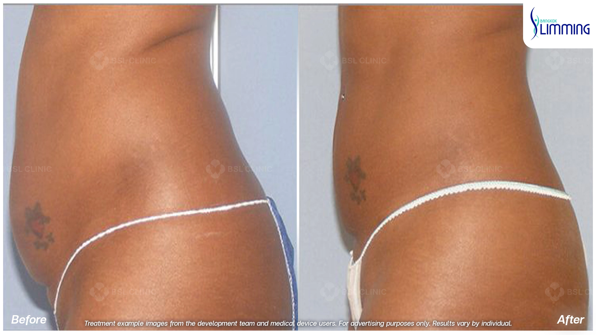 Flank Treatment results