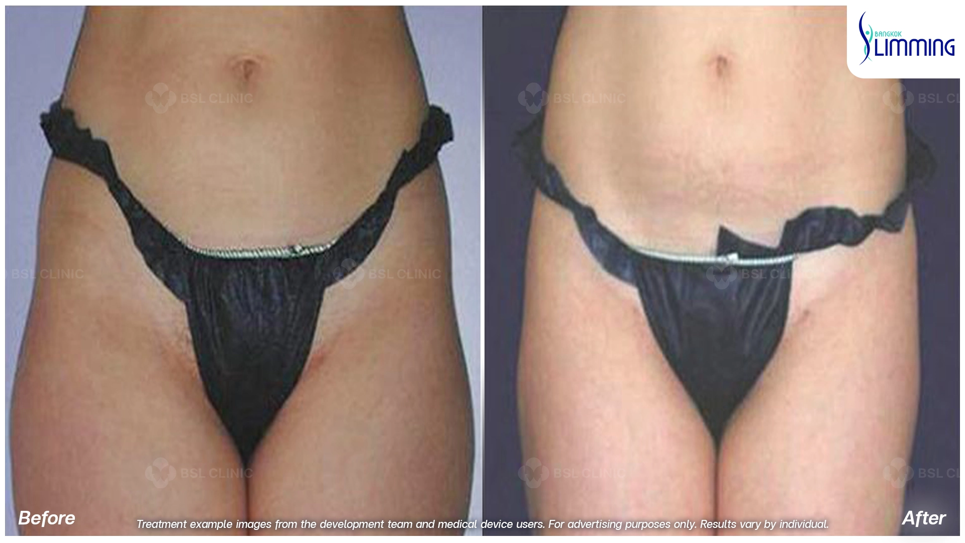Flank Treatment results