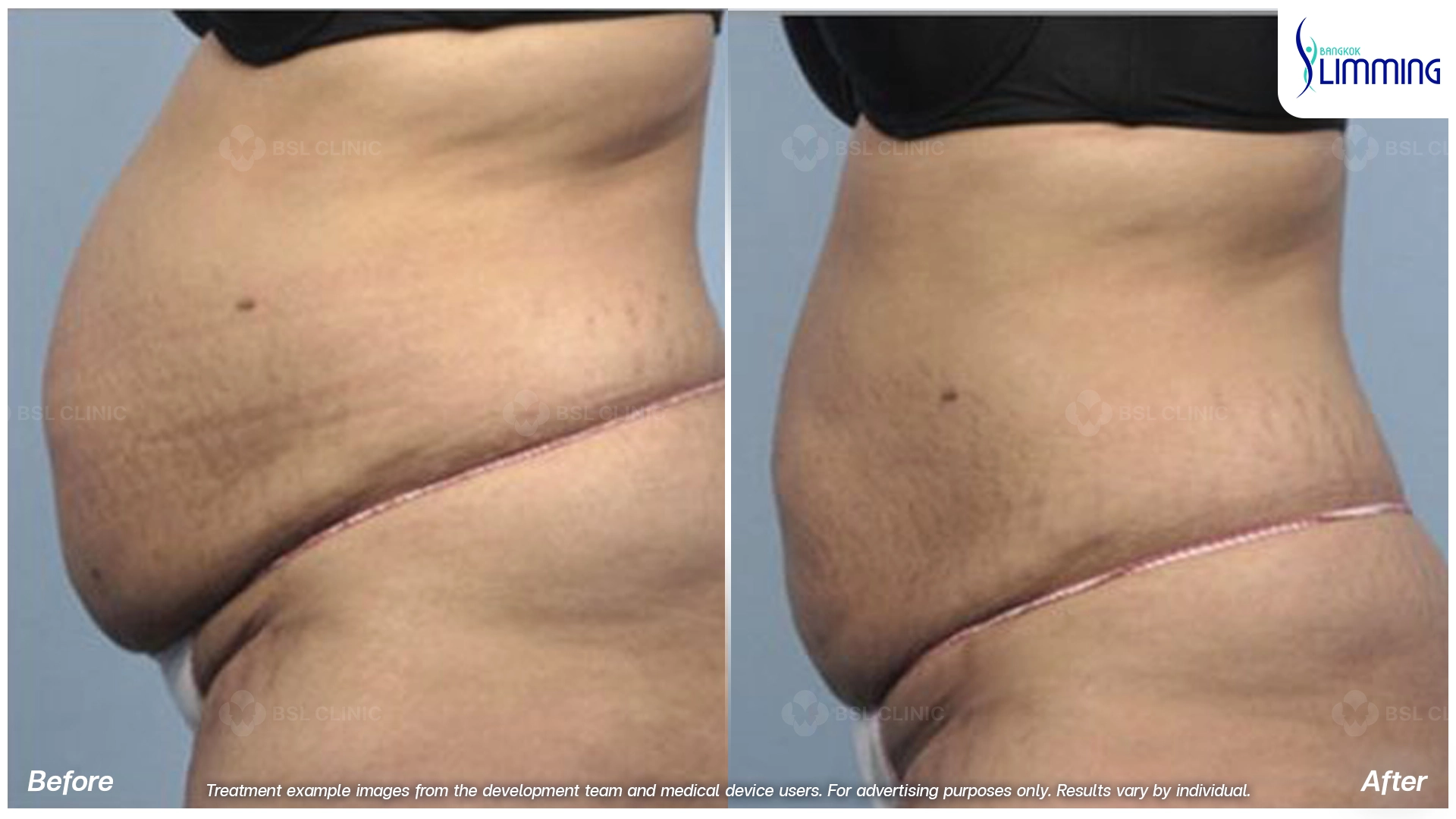 Flank Treatment results