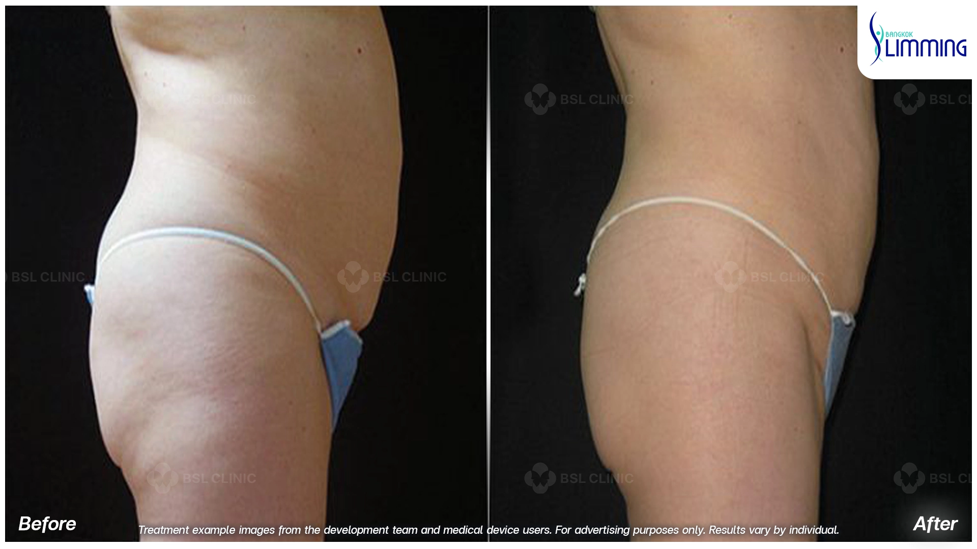 Flank Treatment results