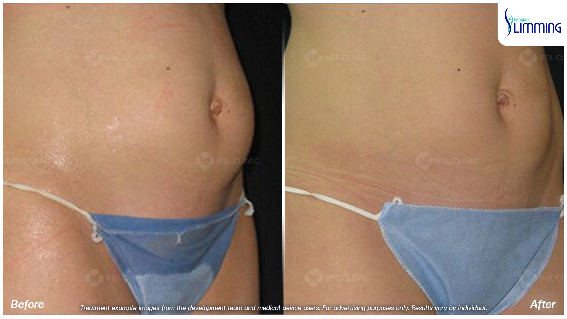 Flank Treatment results
