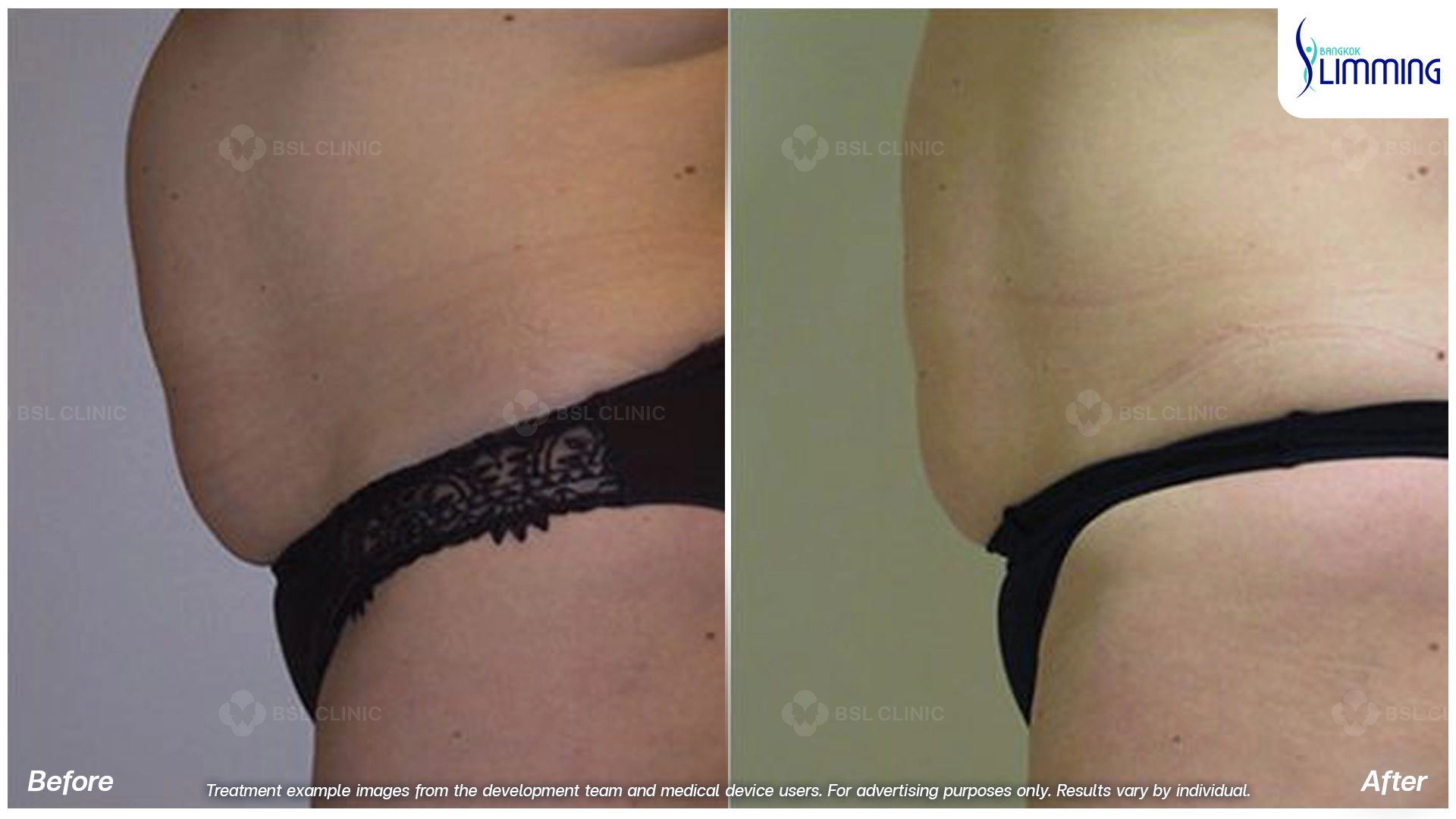 Flank Treatment results