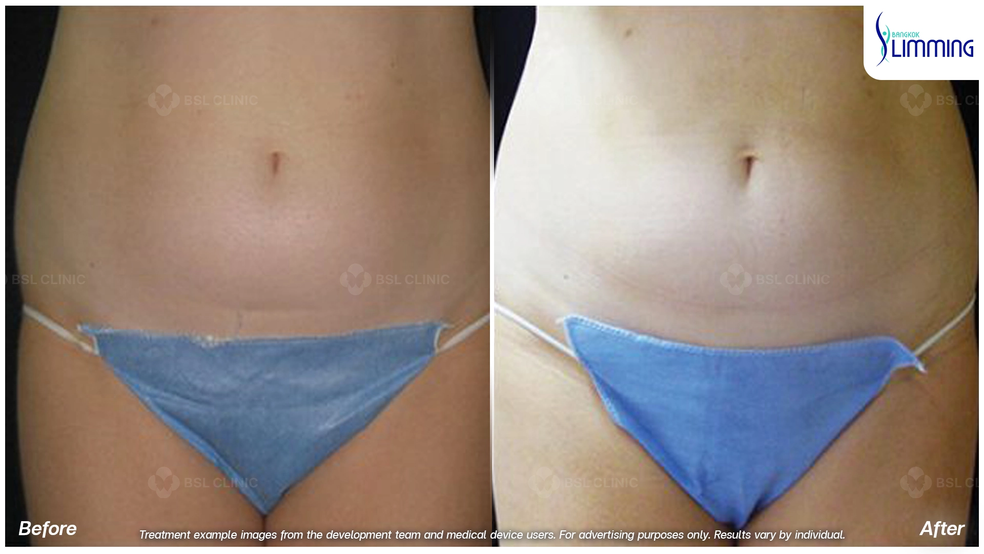 Flank Treatment results