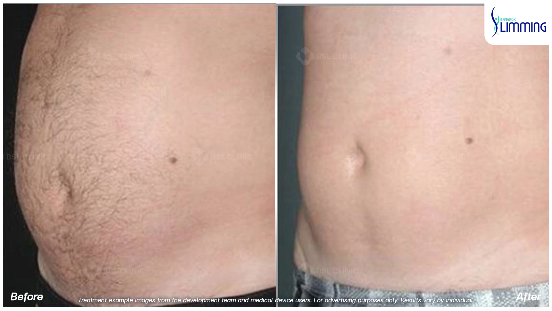 Flank Treatment results