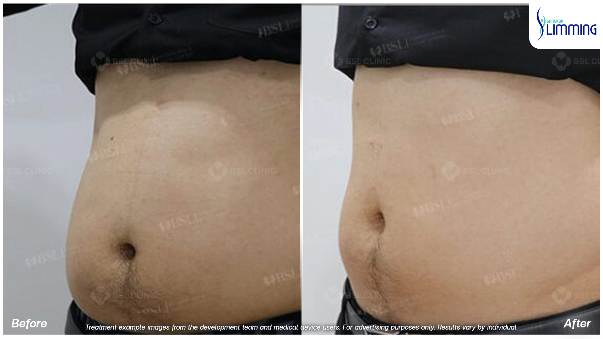 Flank Treatment results