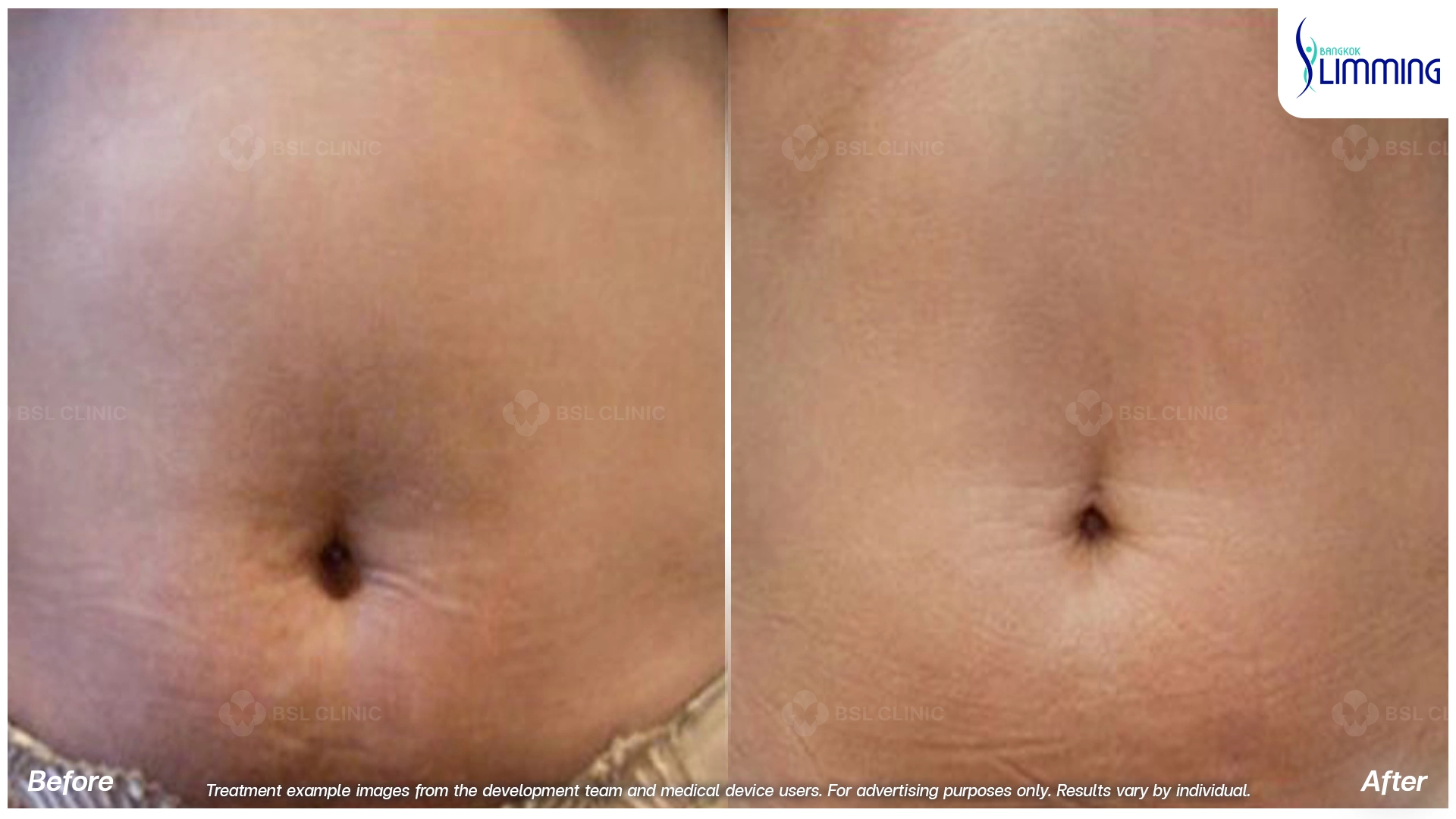 Flank Treatment results