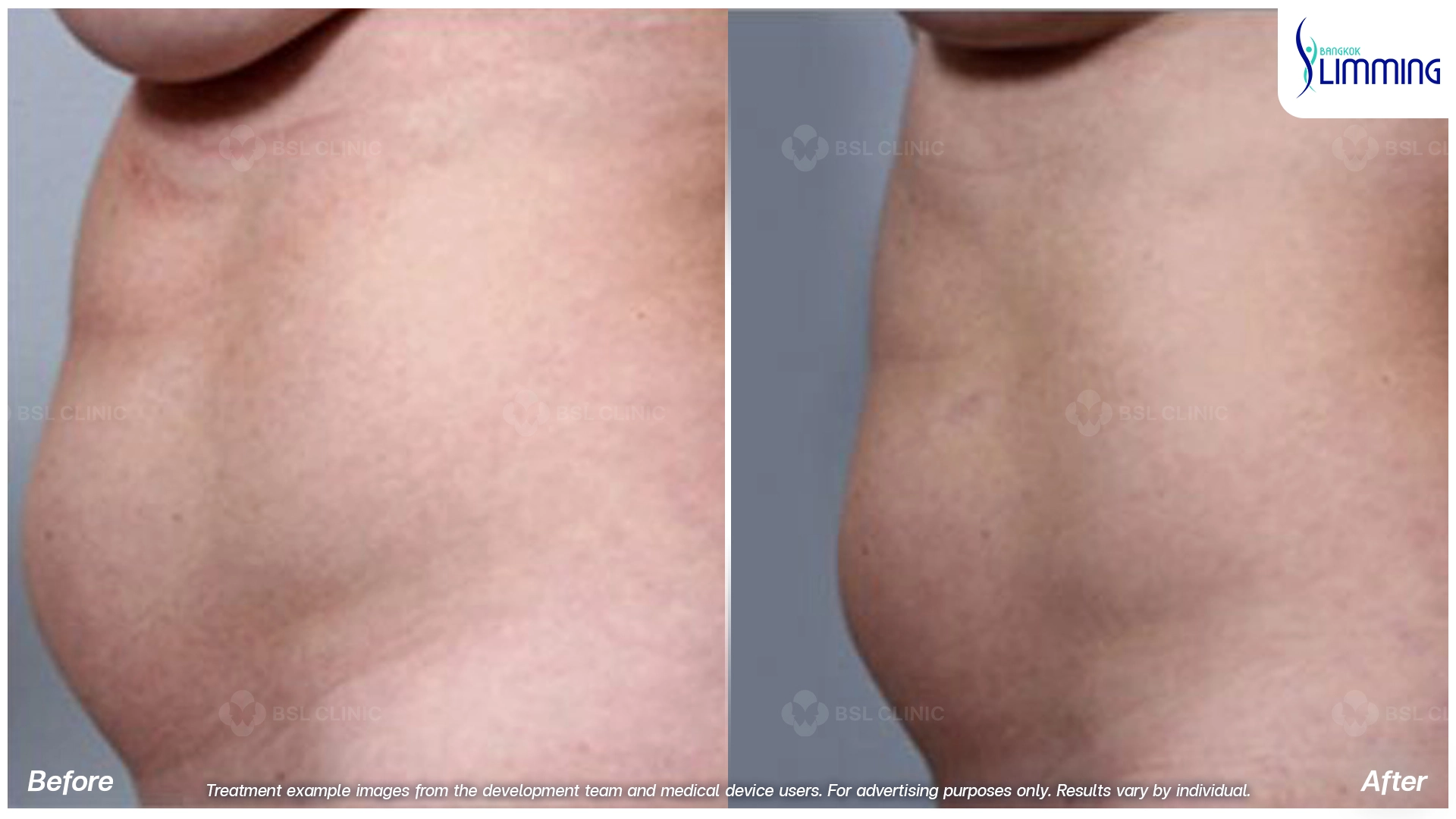 Flank Treatment results