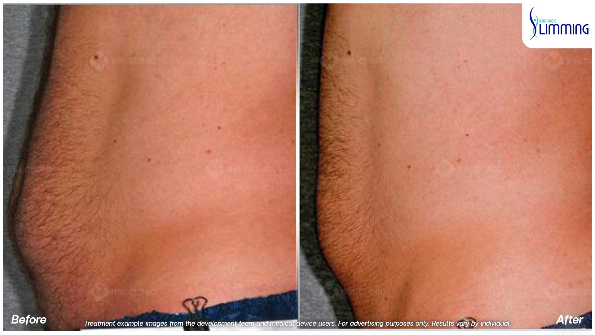 Flank Treatment results