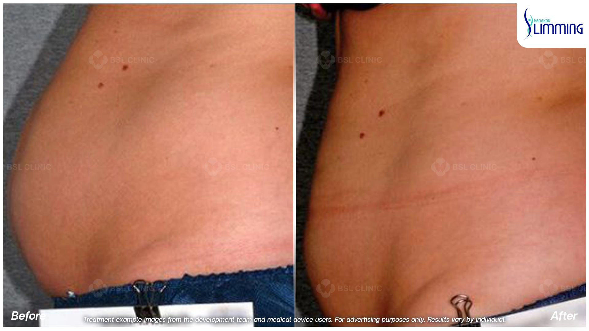 Flank Treatment results