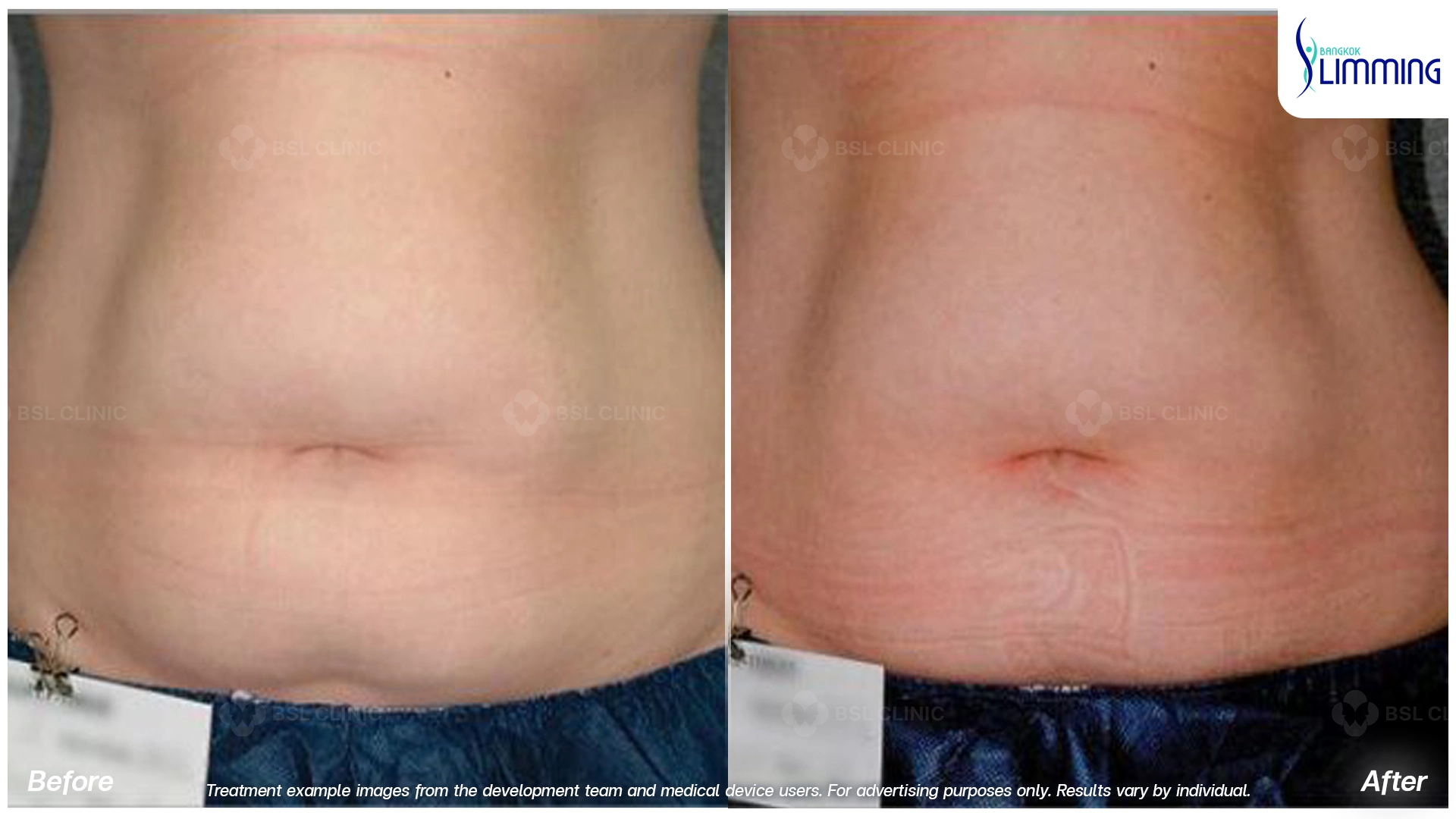 Flank Treatment results