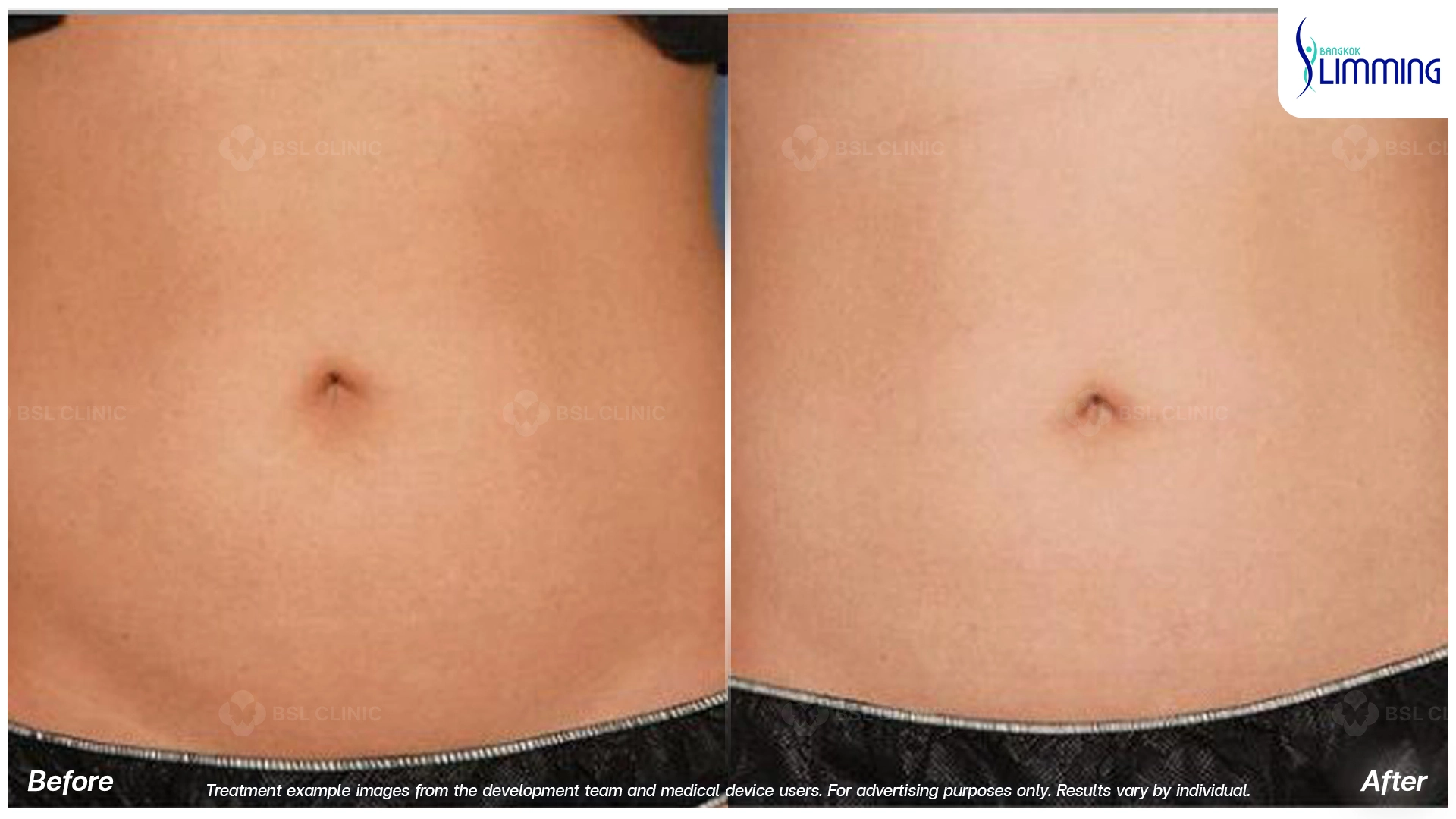 Flank Treatment results