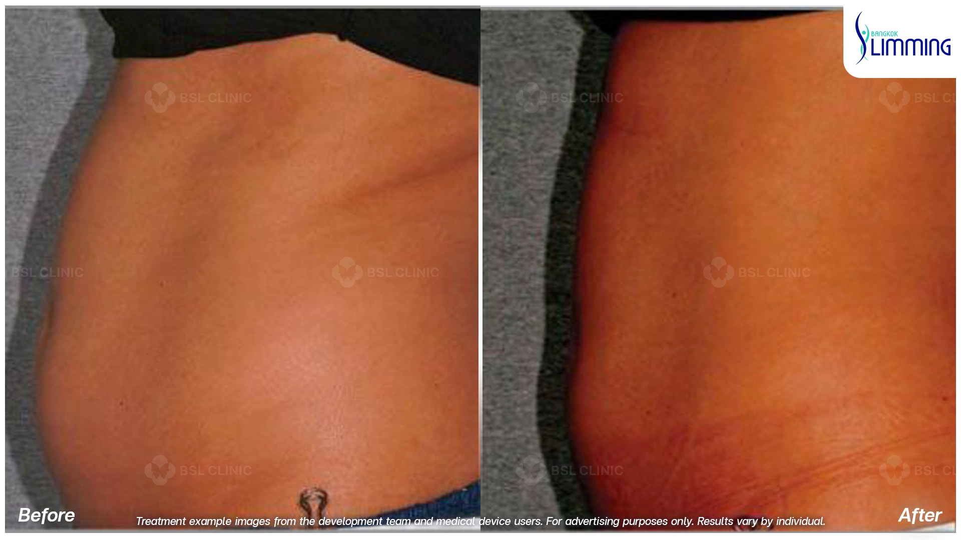 Flank Treatment results