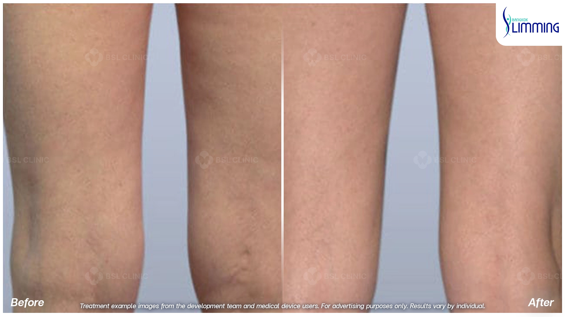 Treatments for Thigh Fat