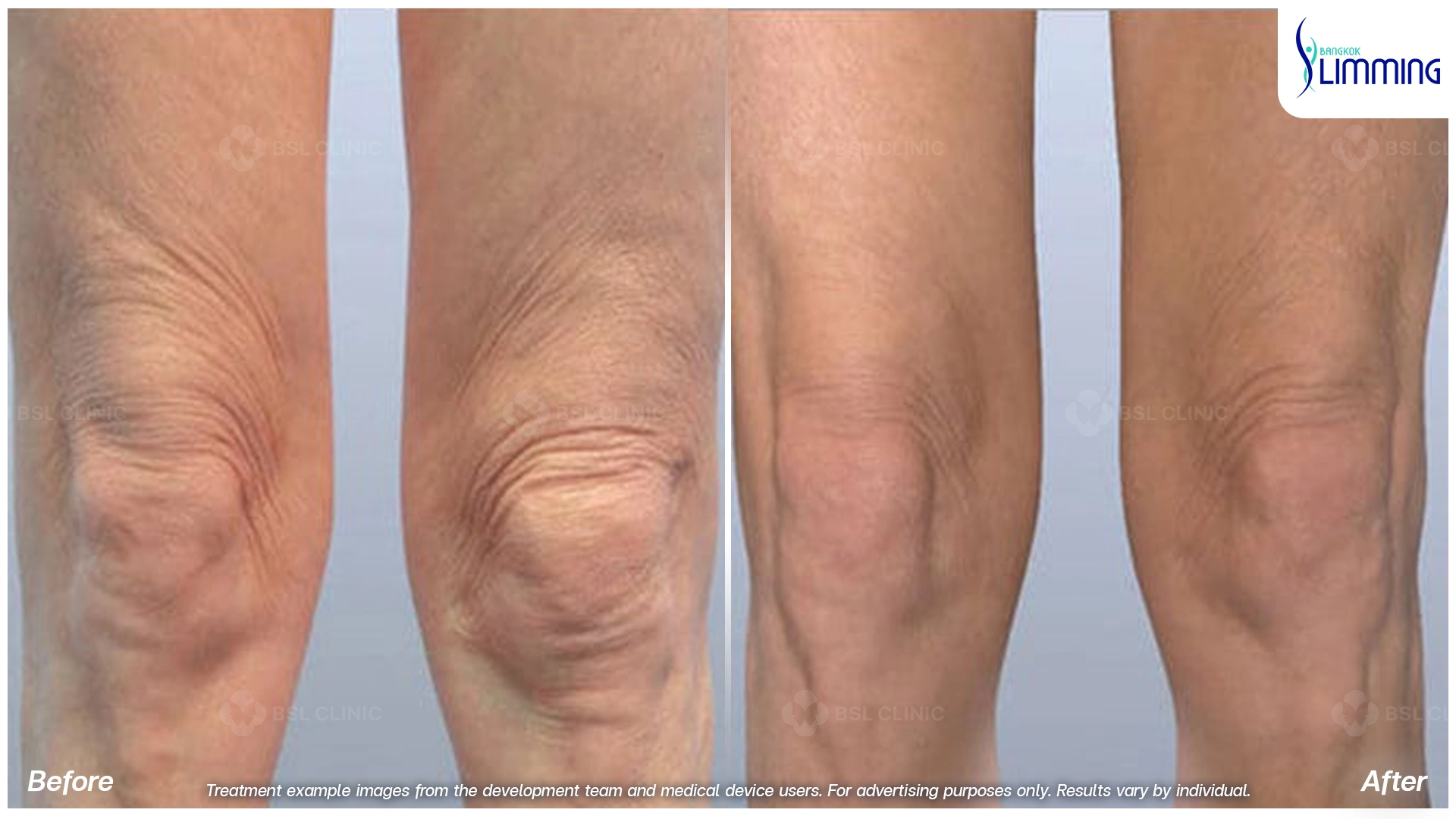 Treatments for Thigh Fat