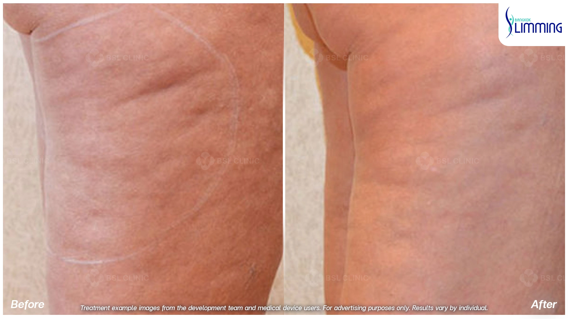 Treatments for Thigh Fat