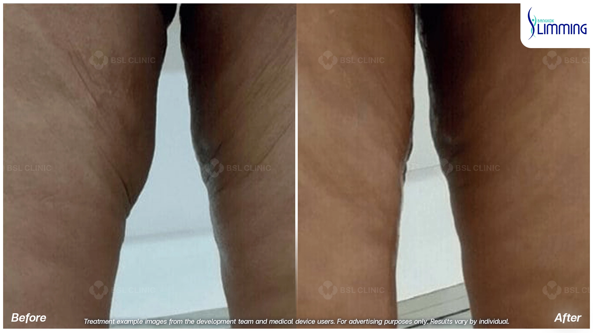 Treatments for Thigh Fat